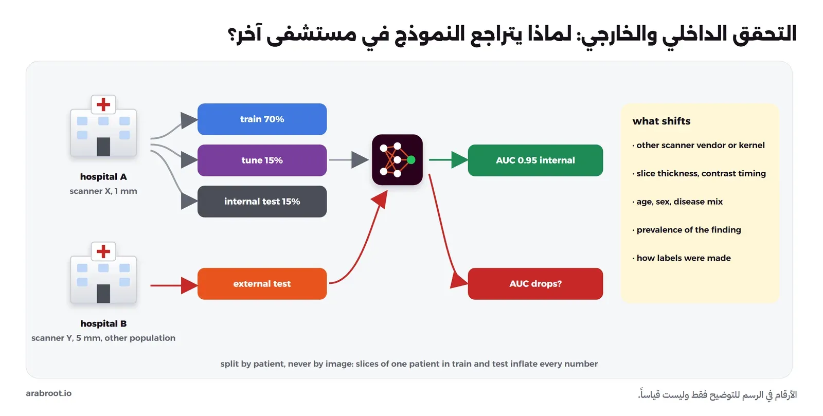 المستشفى A بجهاز X وشرائح 1 مليمتر تقسم بياناته إلى تدريب 70% وضبط 15% واختبار داخلي 15%، والنموذج يعطي AUC مرتفعاً داخلياً، والمستشفى B بجهاز Y وشرائح 5 مليمتر وفئة سكانية أخرى يرسل اختباراً خارجياً، وسهم إلى سؤال هل يتراجع AUC، وعلى اليمين ما يتغير: الشركة المصنعة وخوارزمية البناء، وسماكة الشريحة وتوقيت الصبغة، والعمر والجنس ونوع المرض، وانتشار النتيجة، وطريقة التحديد، وفي الأسفل أن التقسيم يكون بالمريض لا بالصورة